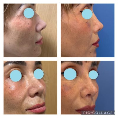 rinoplastia
