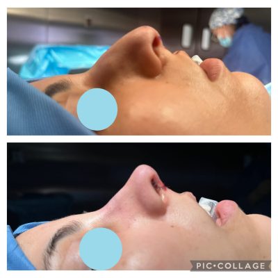 Rhinoplasty