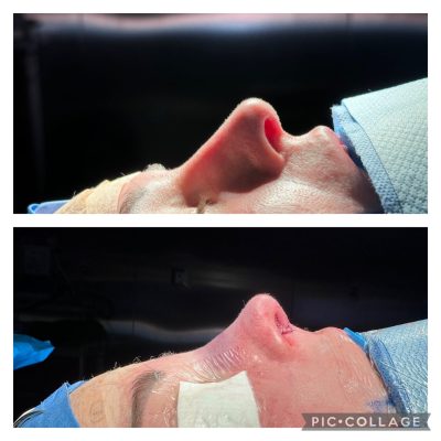 Rhinoplasty results