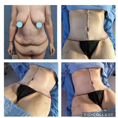 Tummy Tuck