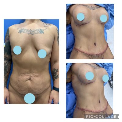 Tummy Tuck Before and After