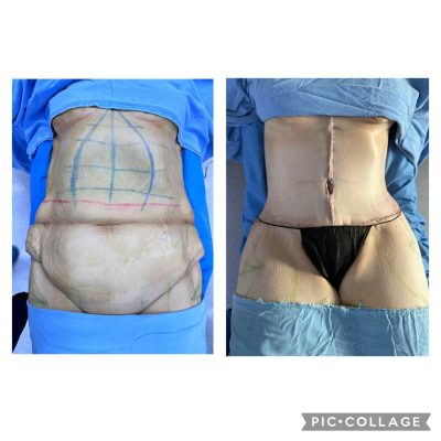 antes y después de una abdominoplastia