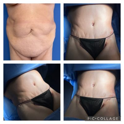 Tummy Tuck results