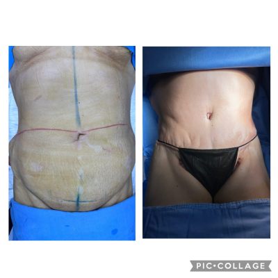 Resultados de la abdominoplastia