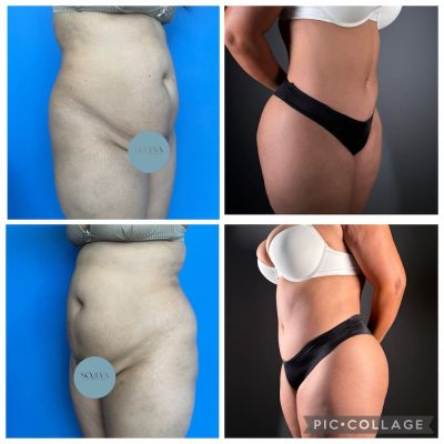 tummy-tuck-tijuana